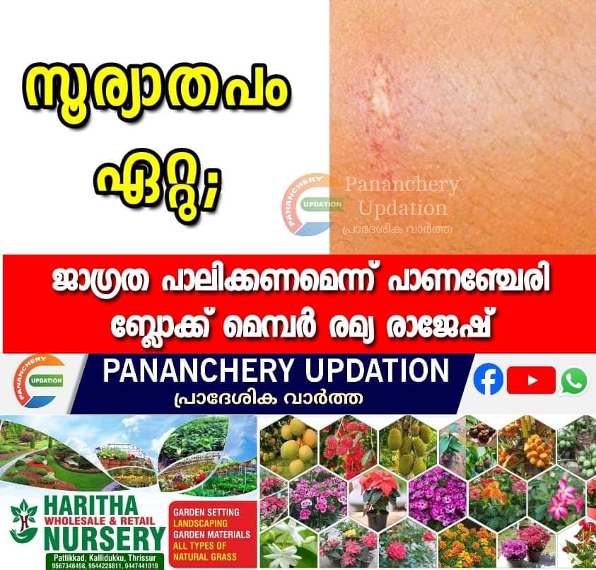 സൂര്യാതപം ഏറ്റു; ജാഗ്രത പാലിക്കണമെന്ന് പാണഞ്ചേരി ബ്ലോക്ക് മെമ്പർ രമ്യ രാജേഷ്