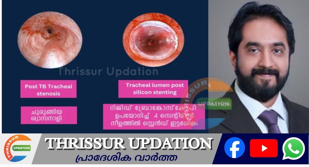 ശ്വാസനാളി ചുരുങ്ങിപ്പോയ മുംബൈ സ്വദേശിക്ക് പുതുജീവിതം